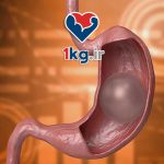 عمل بالون معده؛ راهی غیرتهاجمی برای کاهش وزن