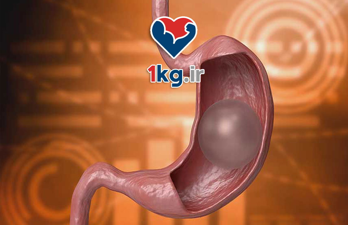 عمل بالون معده؛ راهی غیرتهاجمی برای کاهش وزن