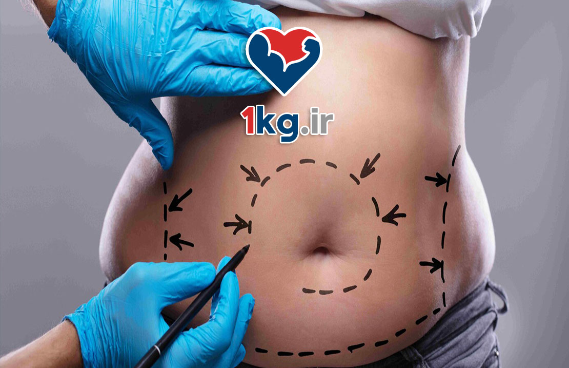 عمل معده لاغری؛ راهی نو برای مبارزه با چاقی