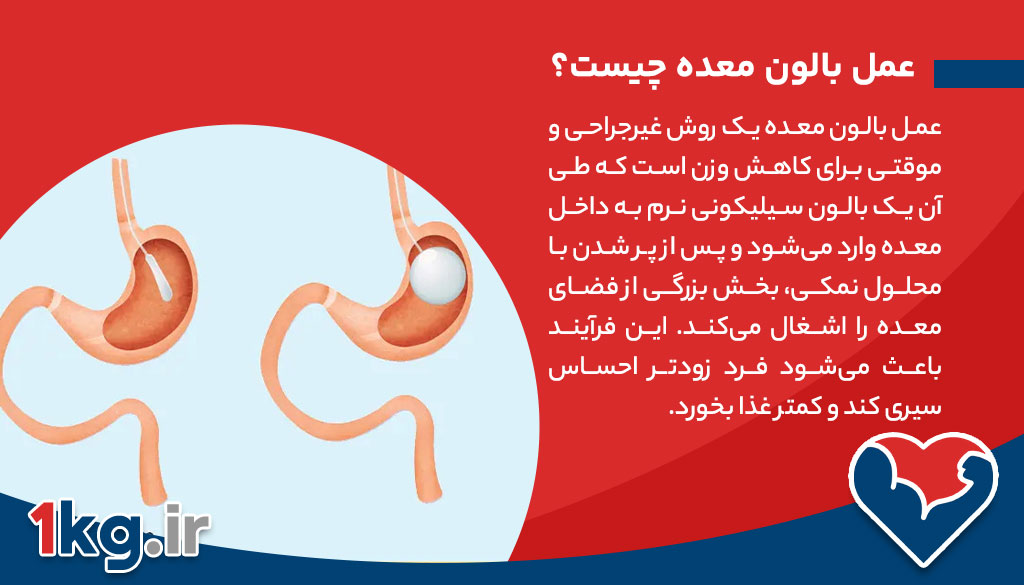 عمل بالون معده؛ راهی غیرتهاجمی برای کاهش وزن