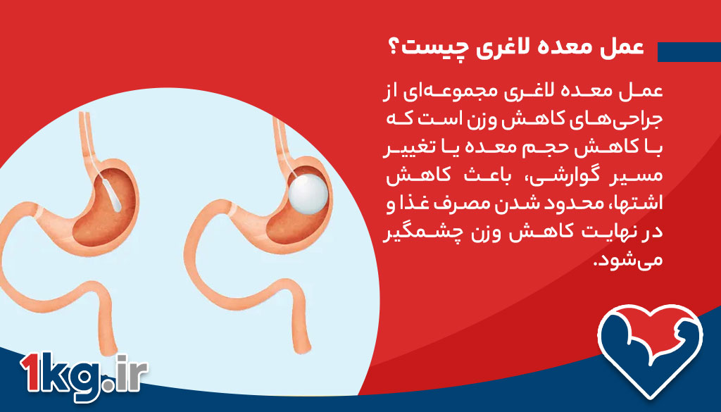عمل معده لاغری؛ راهی نو برای مبارزه با چاقی
