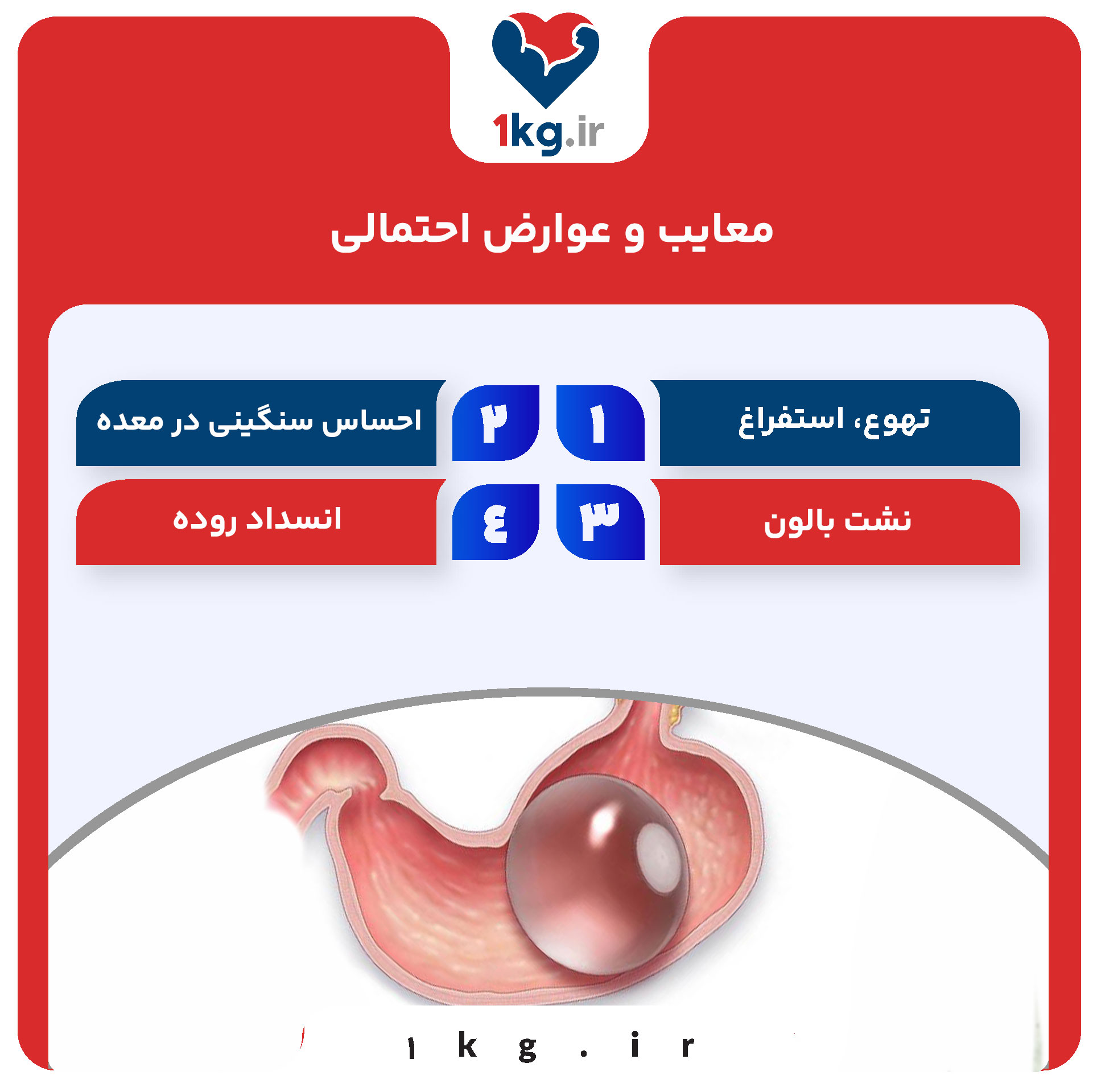 عمل بالون معده؛ راهی غیرتهاجمی برای کاهش وزن 29 عمل بالون معده؛ راهی غیرتهاجمی برای کاهش وزن