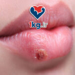 درمان خانگی تبخال: راهکارهایی طبیعی و موثر برای کنترل و بهبود سریع