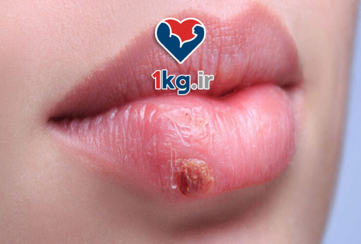 درمان خانگی تبخال: راهکارهایی طبیعی و موثر برای کنترل و بهبود سریع
