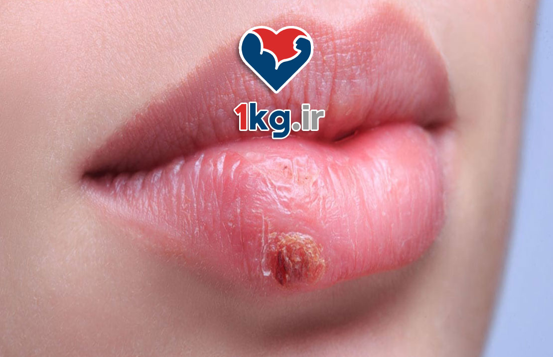 درمان خانگی تبخال: راهکارهایی طبیعی و موثر برای کنترل و بهبود سریع