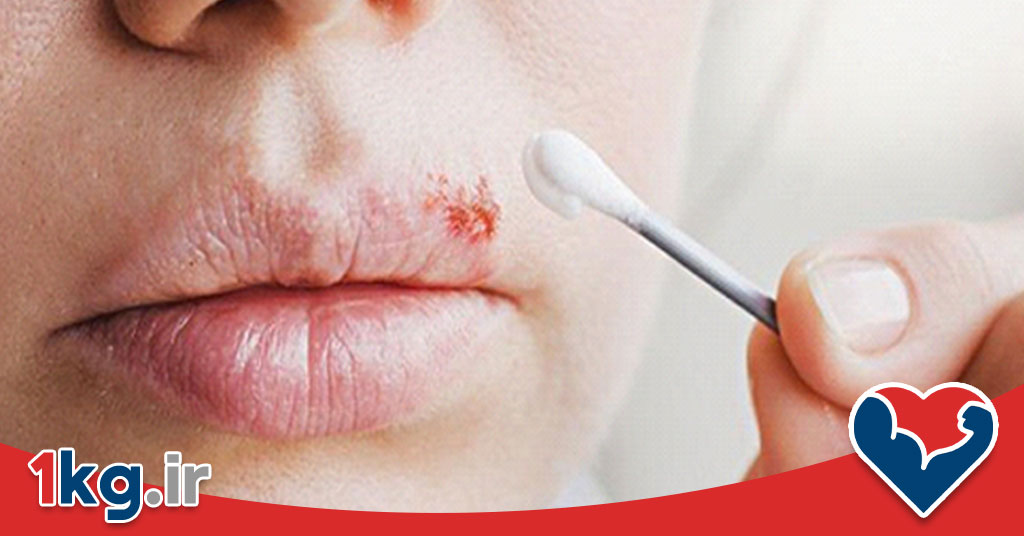 درمان خانگی تبخال: راهکارهایی طبیعی و موثر برای کنترل و بهبود سریع