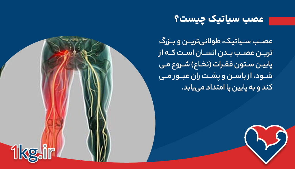 عصب سیاتیک چیست و چگونه درد ایجاد می‌شود؟