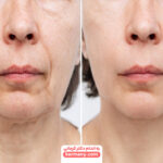 تاثیر لاغری روی صورت