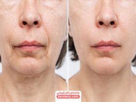 تاثیر لاغری روی صورت