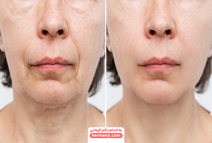 تاثیر لاغری روی صورت