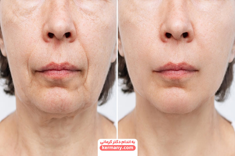 تاثیر لاغری روی صورت