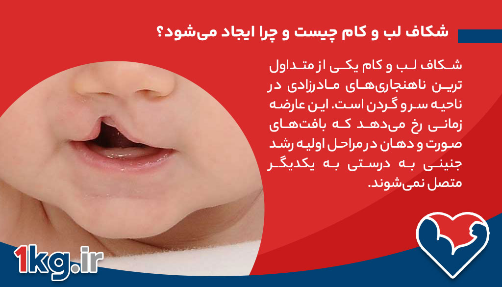 شکاف لب و کام چیست و چرا ایجاد می‌شود؟