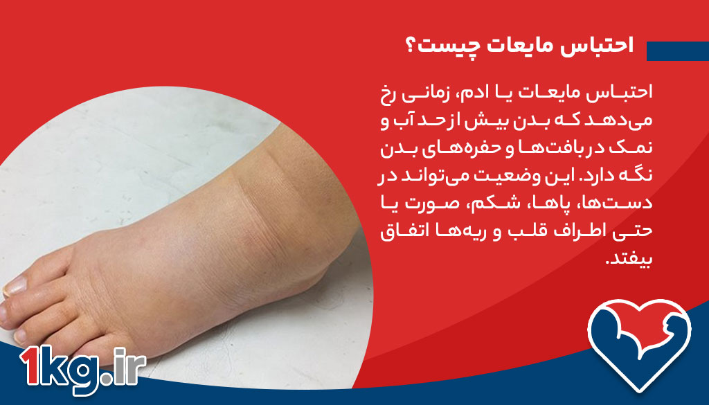 احتباس مایعات و اضافه وزن: همه چیز درباره علل، علائم و راهکارها 26 احتباس مایعات چیست؟