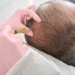 مقایسه مزوتراپی و پی آر پی در درمان ریزش مو