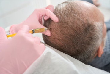 مقایسه مزوتراپی و پی آر پی در درمان ریزش مو 67 مقایسه مزوتراپی و پی آر پی در درمان ریزش مو