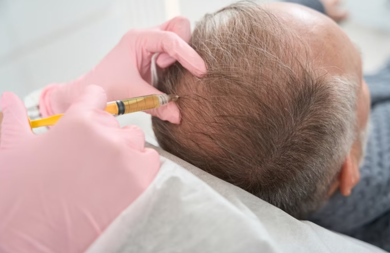 مقایسه مزوتراپی و پی آر پی در درمان ریزش مو 28 مقایسه مزوتراپی و پی آر پی در درمان ریزش مو