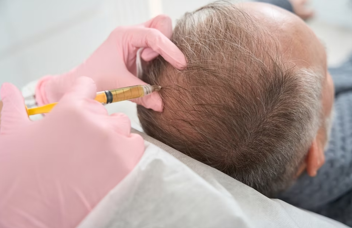 مقایسه مزوتراپی و پی آر پی در درمان ریزش مو 26 مقایسه مزوتراپی و پی آر پی در درمان ریزش مو